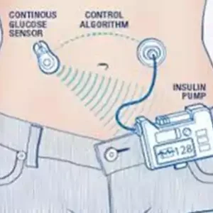 Cuando tu vida depende del hardware II bomba espabilada de insulina